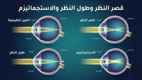 ما هو قصر النظر؟ اضطراب بصري شائع يصيب 1.5 مليار شخص حول العالم