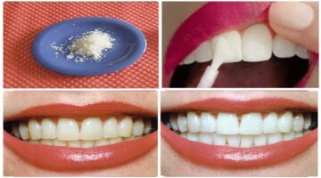 وصفات طبيعية لتبيض الأسنان