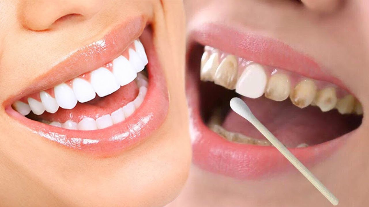 حصرية ومجربة : تبييض الأسنان في المنزل بـ 3 مكونات بمقادير مختلفة والنتيجة ابتسامة مشرقة