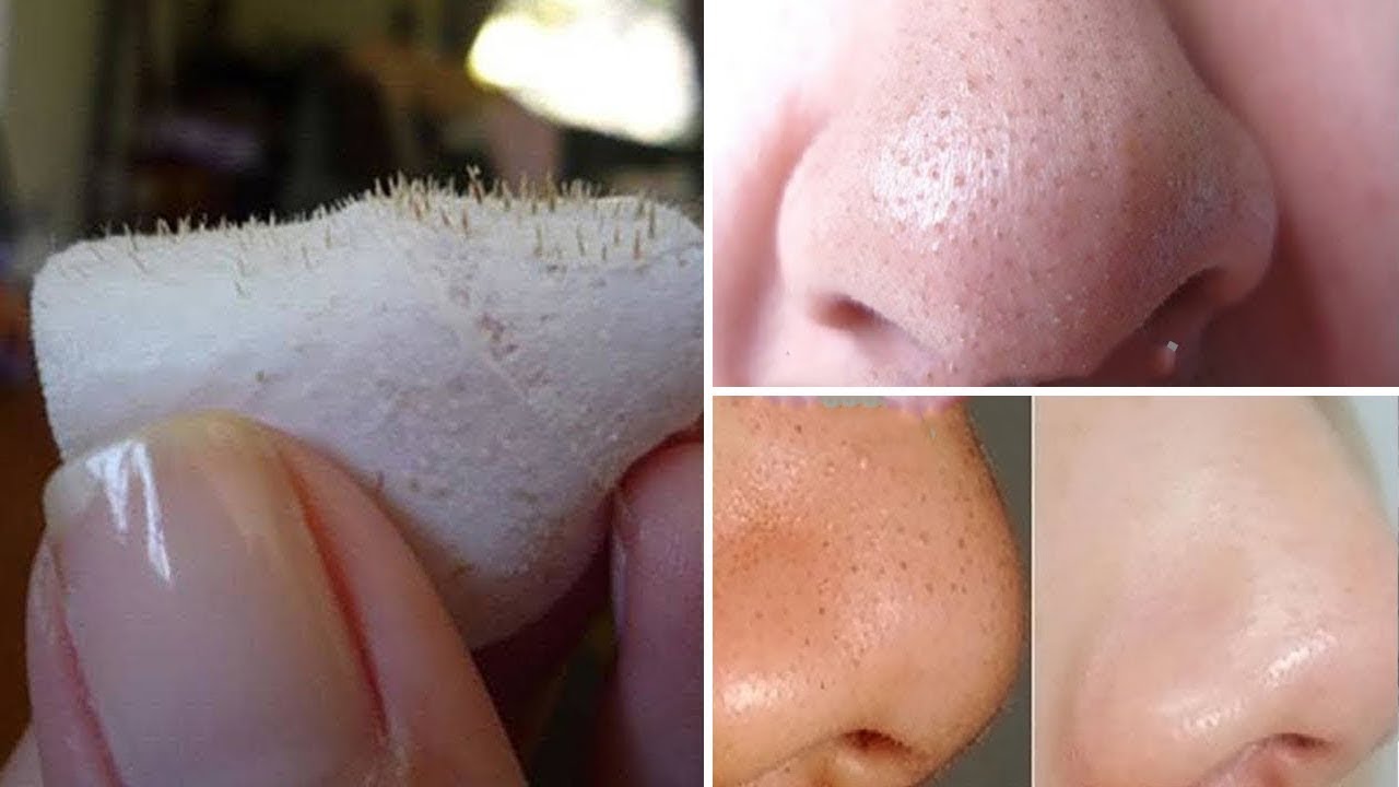 أقوى وصفة طبيعية للتخلص من البثور السوداء في الأنف بمكونات من مطبخك