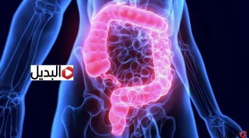 سرطان القولون والمستقيم يزداد بنسة 600%.. اعــرفالاعراض وطريقة الوقاية منه